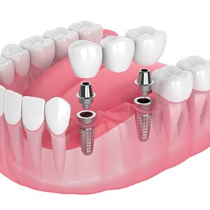 Exploded illustration of dental implants with bridge
