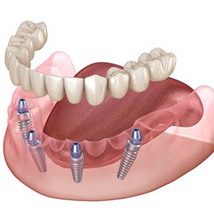 Exploded illustration of implant dentures
