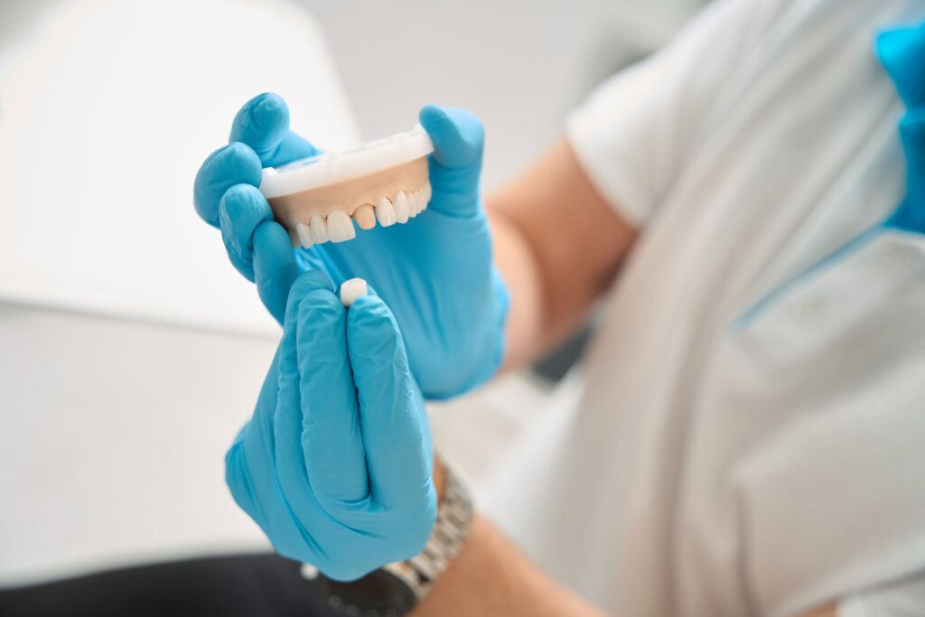 Blue-gloved hands placing crown over model abutment tooth